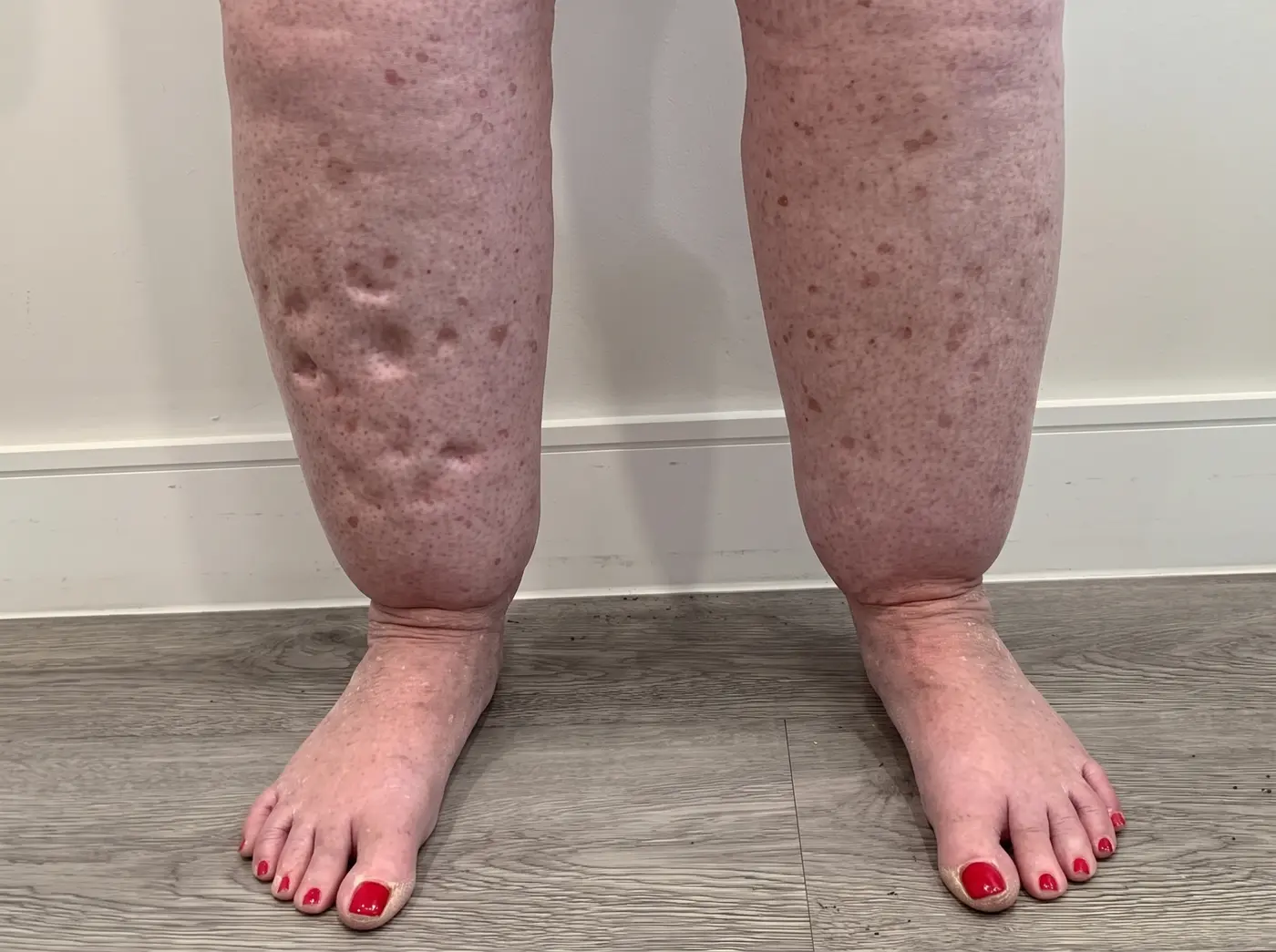 Photograph of lower legs showing texture changes and nodules under the skin